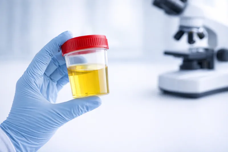 Общий анализ мочи: расшифровка показателей